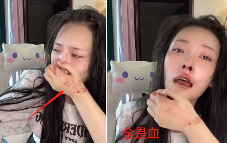 美女网红大琳遭家暴！鼻子被打歪全程嘶吼